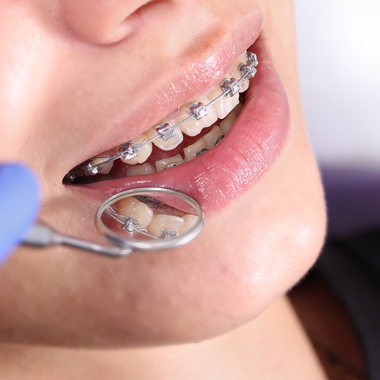 Зубная нить, проф гигиена и ирригатор во время лечения на брекет-системе!