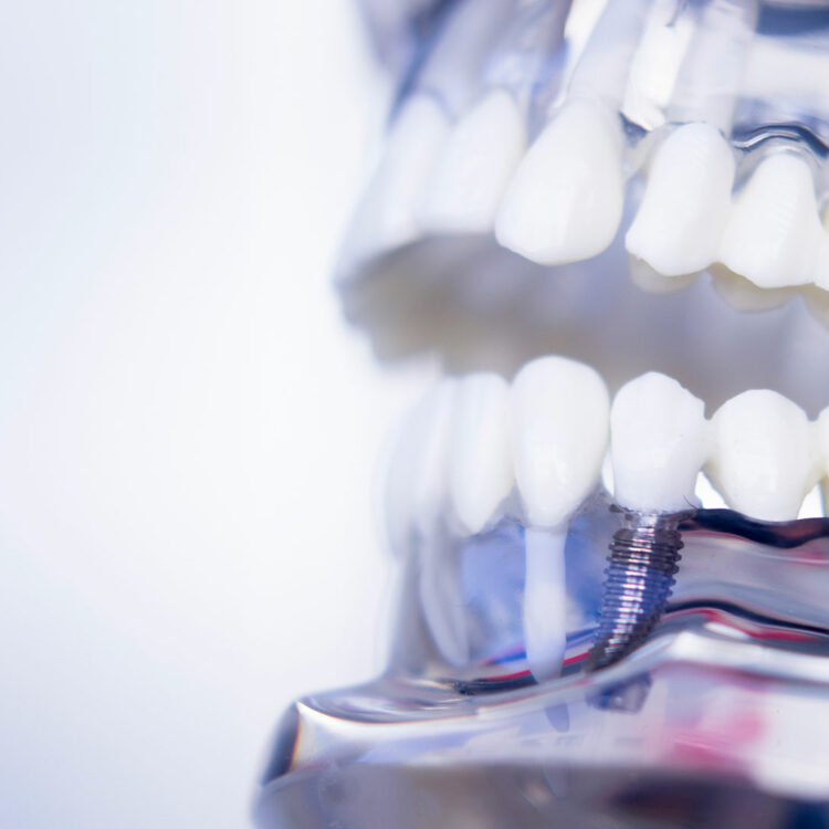 Почему зубная имплантация так популярна?